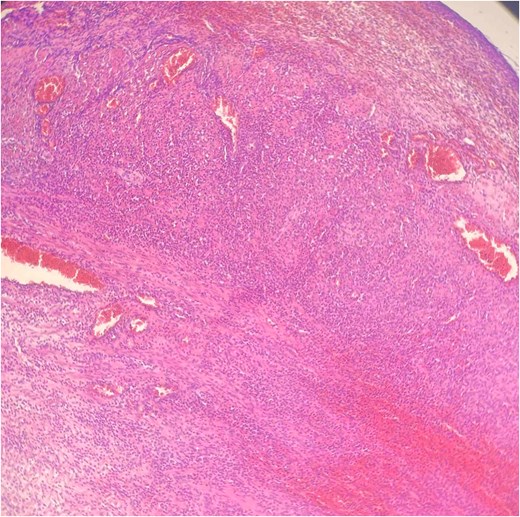 Hematoxylin Eosin (HE) stain 100× transmural acute inflammation with peritonitis.
