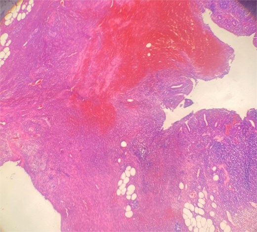 HE 40× wall perforation with hemorrhage and inflammation.