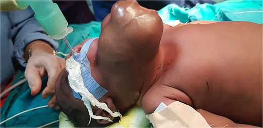 Perioperative picture of the patient showing the extent of facial deformity caused by the tumor.
