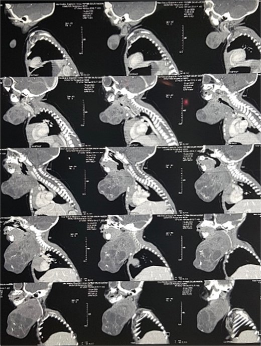 Contrast-enhanced sagittal CT scan of the neck showing the cervical teratoma.