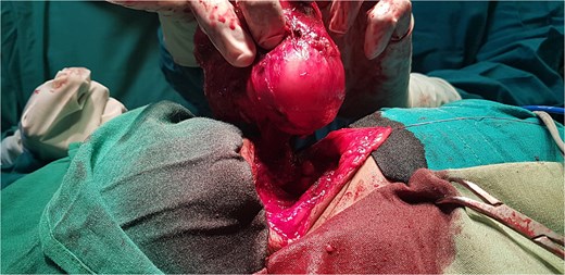 Intraoperative picture during the surgical resection of the cervical teratoma.