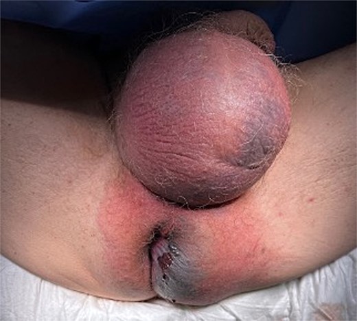 Initial presentation of Fournier’s gangrene.