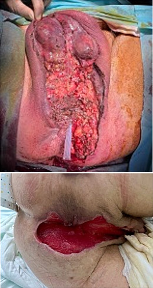 Surgical debridement and early postoperative outcome.