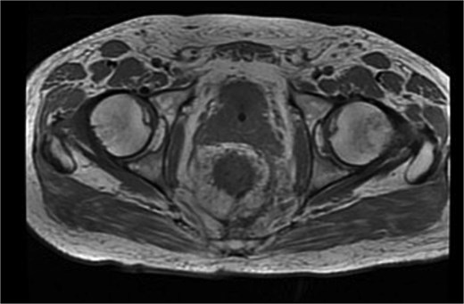 Pelvic MRI staging cT4bN1a.