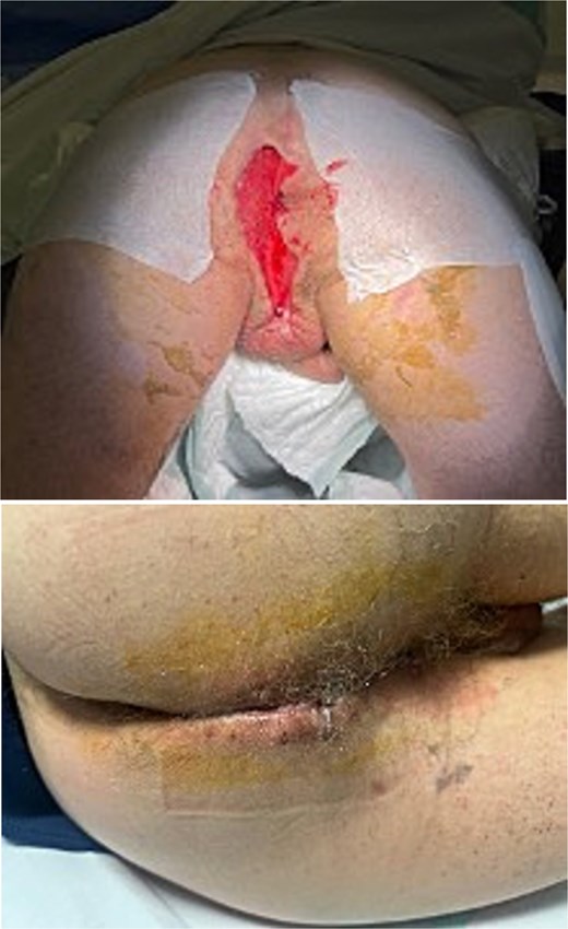 Abdominoperineal resection with favorable perineal healing.