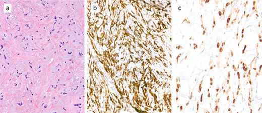 Core biopsy demonstrated a collagen-rich tumour with chondromyxoid stroma of low cellularity (a: haematoxylin and eosin (H&E) stain). The tumour cell expresses immunohistochemically the endothelial marker CD31 (b) and shows nuclear expression of CAMTA1 protein (c), diagnostic of an epithelioid haemangioendothelioma (EHE).
