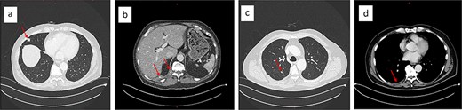 Chest CT showing partially calcified stable 15 × 13 mm subpleural lesion in the lateral middle lobe (a), a paravertebral mass at the level of the T11/12 vertebral foramen, and an intercostal lesion at the level of T10–12 (b). Nodular changes along the oblique fissure (c), and a mild right-sided pleural effusion (d).