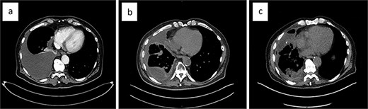 The evolution of the malignant pleural effusion over time. Progressively increasing pleural effusion ~4 months after first identified (a), a loculated pleural effusion after three repeat thoracocenteses, talc pleurodesis, and IPC placement (b); loculated pleural effusion about 2 months after VATS partial empyema evacuation (c).