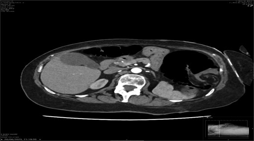 Axial CT showing the swirl sign.