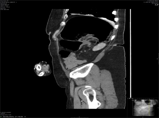 Sagittal CT showing swirl sign and dilated large bowel loops.