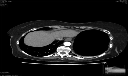Axial CT showing dilated transverse colon at the splenic flexure.