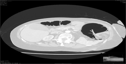 Axial CT lung window showing no evidence of perforation.