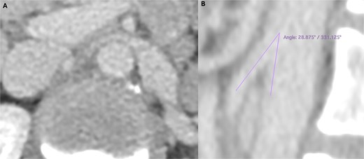Preoperative computed tomography angiography demonstrating compression of the left renal vein in axial section (A) and sagittal section (B), revealing an aortomesenteric angle of 28°.