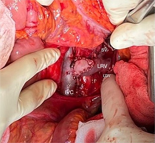 Final outcome of the left renal vein (LRV) transposition with patch angioplasty using bovine pericardium. (LGV: left gonadal vein; SV: suprarenal vein).