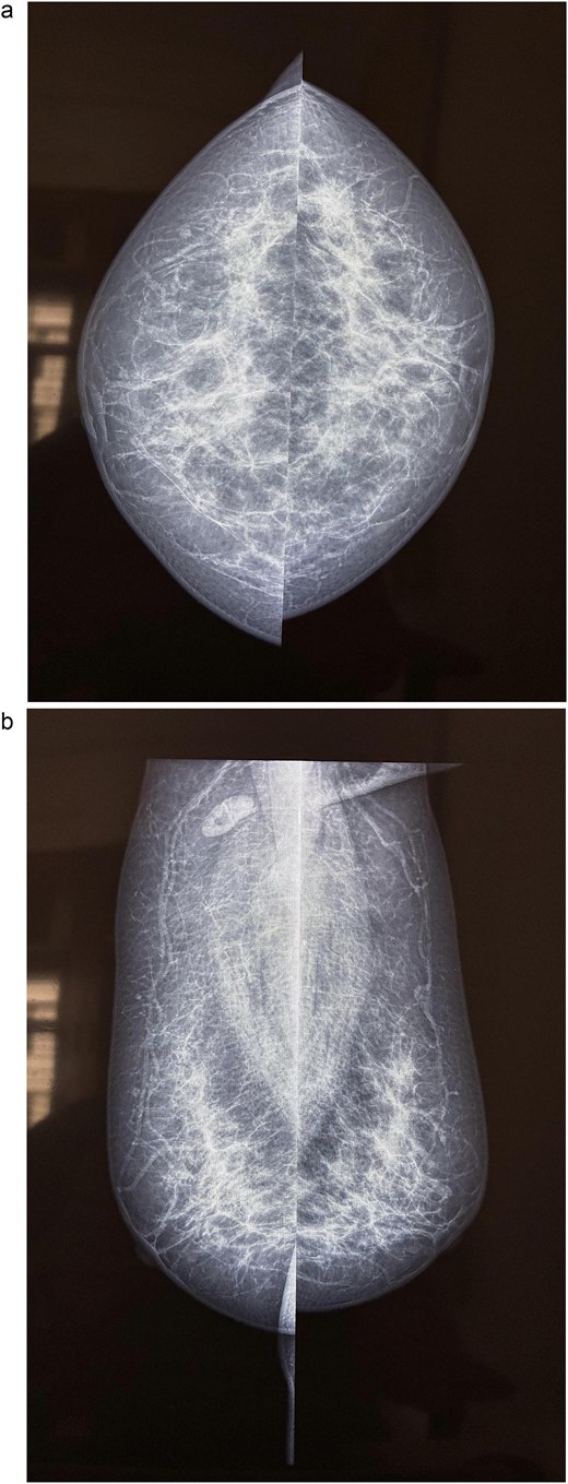 Mammography of the left breast. (a) Craniocaudal view showing a high density spiculated lesion in the upper outer quadrant, consistent with BIRADS 4c/5, suspicious for malignancy. (b) Mediolateral oblique view demonstrating the same spiculated, high density lesion in the upper outer quadrant, corresponding to the known carcinoma (BIRADS 4c/5).