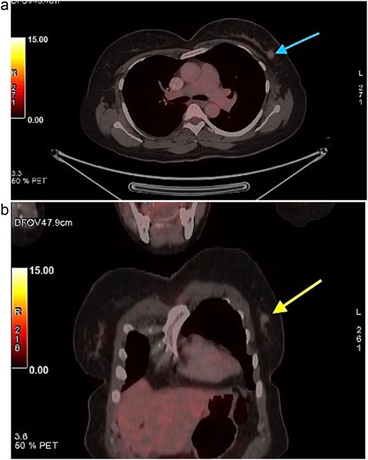 FDG PET CT images of the chest. (a) Axial PET CT image showing a well-defined FDG avid lesion in the upper outer quadrant of the left breast , consistent with the known carcinoma, with no evidence of axillary or mediastinal lymphadenopathy. (b) Coronal PET CT image demonstrating the left breast lesion in the upper outer quadrant without invasion into the chest wall or adjacent structures, consistent with localized disease.