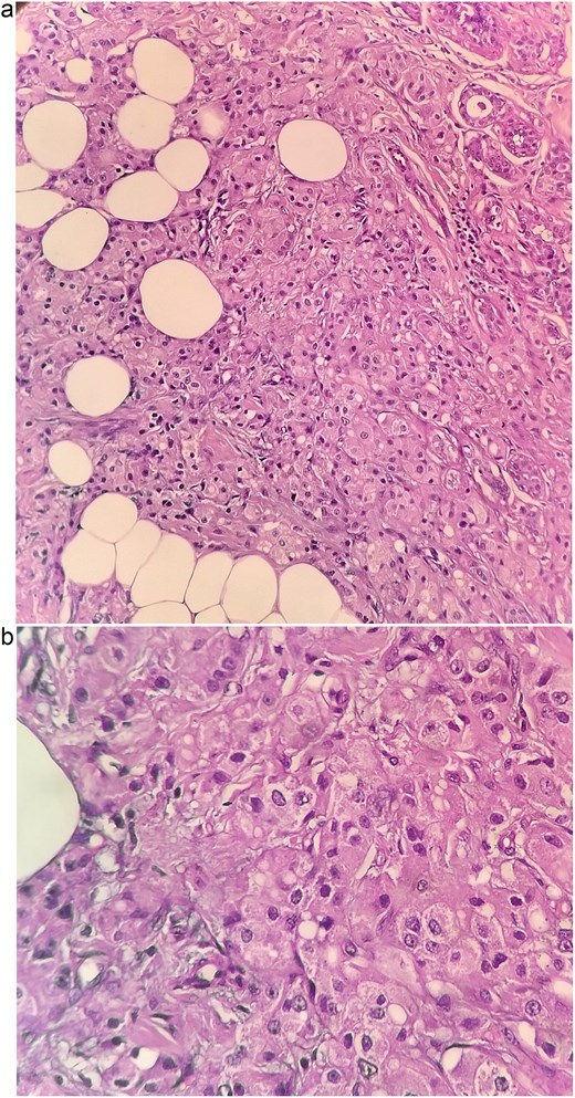 Histopathological sections of the breast lesion showing characteristic apocrine morphology. (a) H&E × 100: Tumor nests composed of large polygonal cells with abundant eosinophilic granular cytoplasm and prominent nucleoli infiltrating fibroadipose tissue. (b) H&E × 400: High power view highlighting the classic apocrine cytology with vesicular nuclei, prominent nucleoli, and abundant eosinophilic cytoplasm. These features are consistent with invasive apocrine carcinoma of the breast.