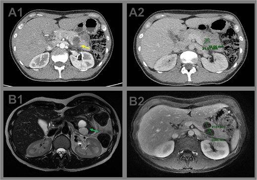 Comparative cross-sectional imaging illustrating progressive growth and signs of rupture in a pancreatic cystic neoplasm. (A1) Axial contrast-enhanced CT image at initial evaluation showing a unilocular cystic lesion at the body–tail junction of the pancreas. The posterior wall appears indistinct (arrow), raising suspicion of partial cyst rupture. (A2) CT measurement of the cystic lesion, with dimensions of 2.1 × 1.8 cm. (B1) Axial T2-weighted MRI performed 2 weeks later reveals a bilobulated cystic lesion in the pancreatic tail, with internal septations (arrow). (B2) Axial T1-weighted MRI shows interval growth of the lesion to 4.0 × 2.1 cm, confirming enlargement and supporting the diagnosis of cyst rupture with associated inflammatory changes.