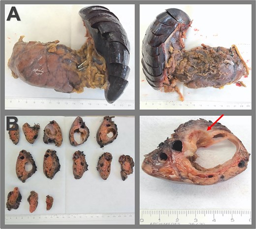 Surgical specimen and macroscopic pathology examination. (A) Specimen of distal pancreatectomy with splenectomy, presented in the anterior and the dorsal view. (B) Macroscopic pathological examination reveals a multiloculated cystic lesion within the pancreas, measuring 3.7 × 2.8 × 2.7 cm, fibrous cyst wall up to 0.2 cm, an adjacent firmer region measuring 3.0 cm extending to the posterior surface of the pancreas, and signs of capsular rupture (arrow).