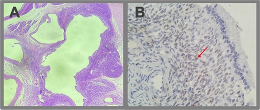 Microscopic pathologic examination. (A) Histological sections of the cystic lesion reveal a mucinous epithelial lining with regular nuclei, without atypia or architectural complexity. The capsule consists of dense connective tissue and contains areas of more cellular stroma, characterized by spindle cells without significant atypical or mitotic activity (ovarian-like stroma). A region of the capsule is replaced by granulation tissue, with evidence of prior hemorrhage and fibrosis extending to the posterior surface of the pancreas. No evidence of invasive neoplasia is observed. (B) Immunohistochemistry revealed strong positivity for estrogen receptors in the ovarian-type stromal cells, indicated by brown staining (arrow).