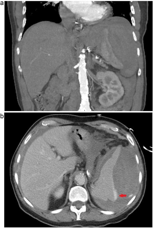 (a) Coronal computed tomographic angiogram image of ruptured spleen with large amount of surrounding perisplenic hematoma. (b) Axial computed tomographic angiogram image of ruptured spleen, arrow indicating extravasation of contrast dye.