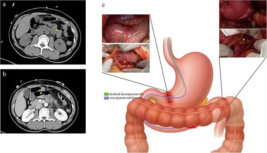 (a) Initial non–contrast abdominal CT on presentation demonstrating slight peripancreatic fluid collection, mild wall thickening, and edema of the proximal jejunum (yellow star). (b) Contrast-enhanced CT performed 8 hours later, showing extraluminal air (yellow star) and contrast leakage (red triangle) at the junction of the ascending duodenum and proximal jejunum. (c) Intraoperative view showing serosal lacerations of the stomach and transverse colon, with perforations of the ascending duodenum and proximal jejunum (yellow star denotes the main defect; red triangle indicates a smaller perforation identified endoscopically), and the positions of the duodenal decompression tube (purple) and nasojejunal feeding tube (green).