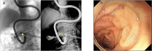 (a) Contrast radiograph of the ascending duodenum and proximal jejunum demonstrating luminal continuity without perforation. (b) Follow-up enteroscope illustrating localized mucosal scarring at the site of duodenal perforation repair.