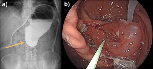 (a) Barium swallow showing evident contrast retention gastric outlet obstruction due to the anastomotic stenosis. (b) Endoscopic view of edematous stenosis causing gastric outlet obstruction, bypassed by the endoscope.