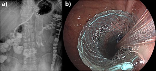 (a) Fluoroscopic control image showing placement of FCSEMS and nasojejunal tube, followed by passage of contrast through the site of stenosis. (b) Endoscopic view of the placement of FCSEMS at the site of edematous stenosis.