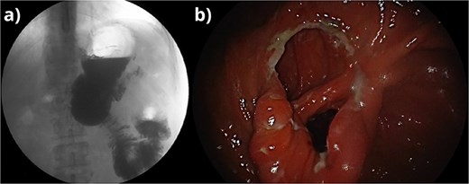 (a) Fluoroscopic control image post FCSEMS retrieval showing resolution of the stenosis and passage of contrast through the intestine. (b) Endoscopic view of the site of the stenosis after systemic steroid therapy and FCSEMS retrieval.