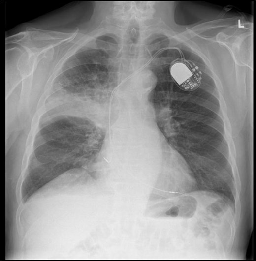 CXR showing right upper lobe consolidation with a small right pleural effusion (dual lead pacemaker noted).