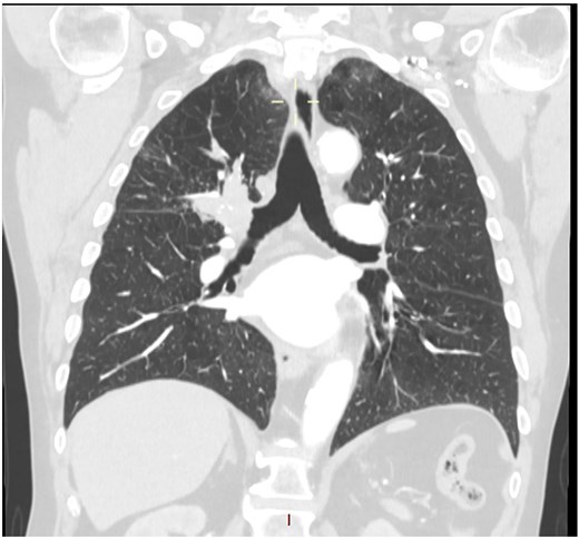 CT scan (coronal section) showing a large endobronchial lesion within the right upper lobe bronchus causing distal collapse of the right upper lobe.