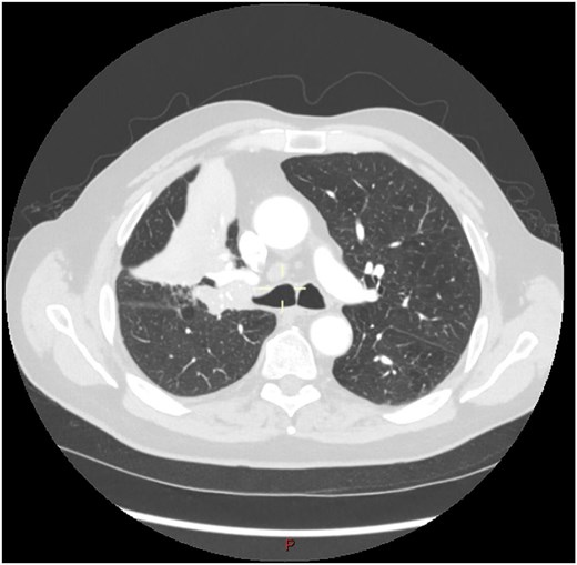 CT scan (transverse section) showing a large endobronchial lesion within the right upper lobe bronchus causing distal collapse of the right upper lobe.