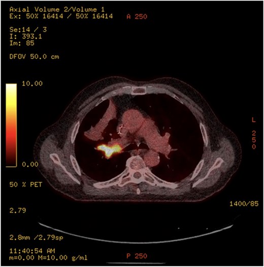 PET-CT showing an endobronchial lesion that measures 3.8 × 2 cm and is fluorodeoxyglucose avid (SUV max 13.8 g/ml).