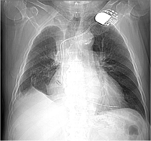 Scout CT scan showing postoperative volume loss in right hemithorax.