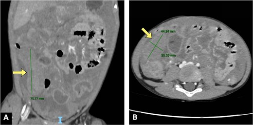 Abdominal CT in the (A) coronal plane and (B) axial plane demonstrates a dilated appendix (yellow arrows) with a moderate amount of peritoneal fluid.