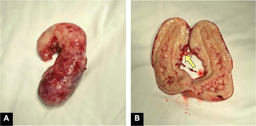Surgical specimen. Macroscopic examination: (A) firm, sausage-shaped appendix with a thickened wall and edematous mucosa resulting in luminal narrowing; (B) discontinuity of the appendiceal serosa at the body (yellow arrow).