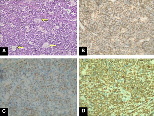 The H&E stain ×400 magnification. The tumor cells are densely arranged, interspersed with many pale macrophages containing nuclear debris, creating the typical ‘starry-sky’ pattern. (A) The background lymphocytes form the sky, while the macrophages represent the stars (arrows). (B) Immunohistochemistry (IHC) × 100: CD20 positivity, (C) BCL6 positivity, and (D) Ki67 expression (~100%).