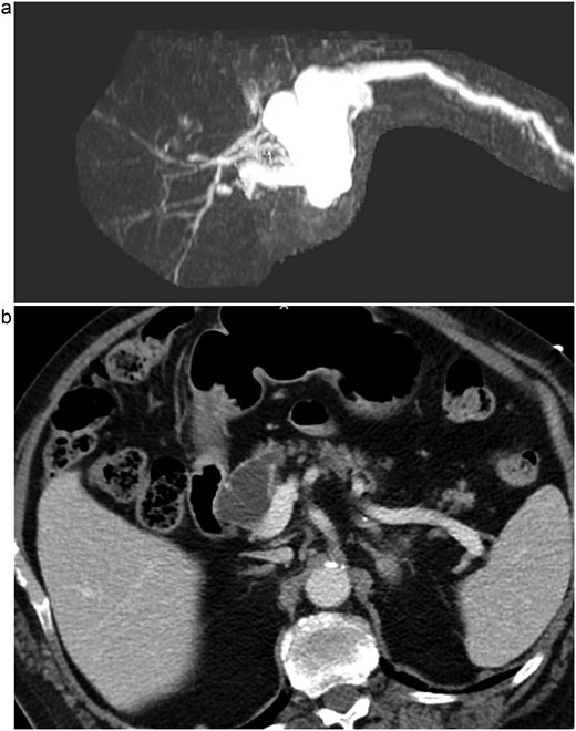 (a) MRI/MRCP imaging of the cystic lesion of the pancreatic head with involvement of the main pancreatic duct. (b) CT imaging illustrating the main duct IPMN at the head of the pancreas.