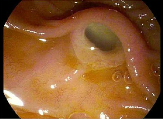 Endoscopic evaluation and classic “fish mouth” appearance of the ampulla.