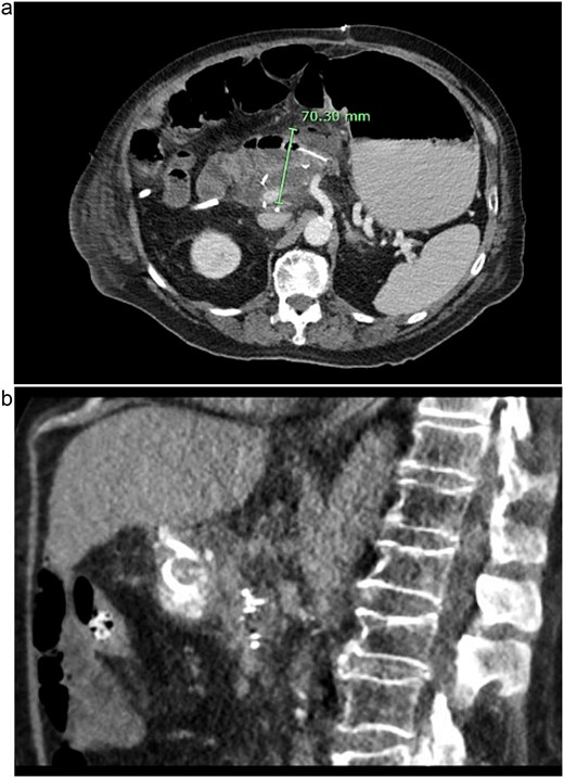 CT images of this patient’s post-operative pancreatic fistula (a) prior to IR guided intervention; (b) after percutaneous jejunostomy that was confirmed to rest within the blind jejunal end of the afferent loop after pancreaticoduodenectomy.
