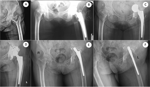 From femoral neck fracture and bipolar hemiarthroplasty to acetabular perforation, conversion THA, and acetabular component removal. (A) Anteroposterior (AP) pelvis radiograph demonstrating a displaced femoral neck fracture. (B) Immediate postoperative AP view after bipolar hemiarthroplasty using a standard femoral stem. (C) Subsequent acetabular perforation with intrapelvic migration of the bipolar head. (D) Conversion to total hip arthroplasty with an acetabular component supported by a cup–cage construct. (E, F) Same sitting: AP and cross-table lateral views obtained at the time of acetabular component explantation, delineating extensive acetabular bone loss. AP, anteroposterior.