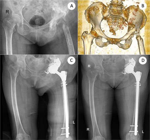 Definitive salvage re-revision THA: Defect assessment after femoral explant (AP and 3D-CT) and final reconstruction. (A) AP pelvis after removal of the femoral component showing severe acetabular and proximal femoral bone defects. (B) Three-dimensional computed-tomography (3D-CT) reconstruction corresponding to (A), confirming mixed cavitary–segmental acetabular defects. (C) Immediate postoperative AP radiograph after salvage re-revision total hip arthroplasty using a cup–cage acetabular reconstruction and a 260-mm modular tapered femoral stem secured with two distal interlocking screws. (D) AP X-ray taken 10 months after re-revision. AP, anteroposterior; 3D-CT, three-dimensional computed tomography; THA, total hip arthroplasty.