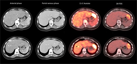 Heterogeneous radiological appearance of the tumours. Lateral S2 tumour was hypodense on arterial phase, and with 11C-acetate and 18FDG avidity; S4a tumour (arrow) was arterial enhancing but nonavid on PET. S8 lesion (*) was arterial enhancing and with 11C-acetate but not 18FDG avidity.