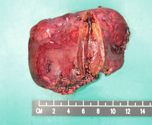 Resected left lateral section showing multiple tan-coloured nodular tumours.