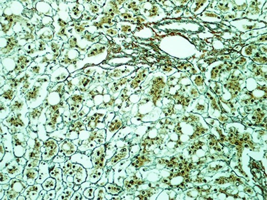 Section of the S2 nodule (magnification 200×). Reticulin stain revealed preserved reticular meshwork in most areas.