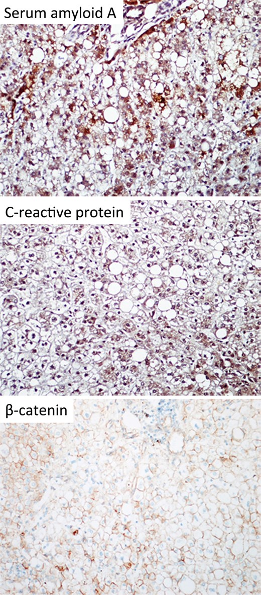 Immunohistochemical staining of the resected specimen (magnification 200×). The tumour cells expressed SAA and CRP. No nuclear expression was observed with β-catenin.