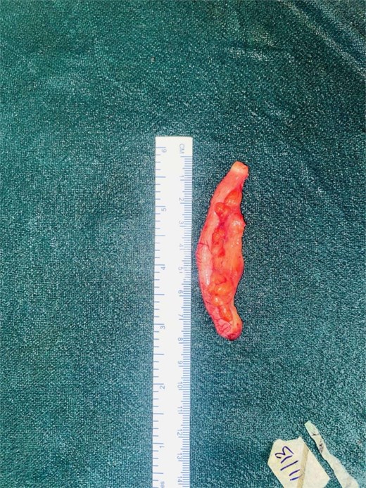 Grossly normal looking vermiform appendix.