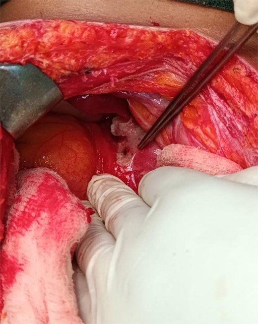 Intra-operative finding showing ~5 × 3 mm perforation.