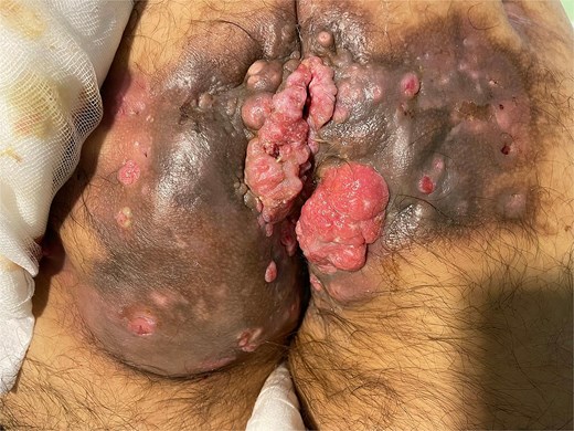 Massive squamous cell carcinoma.